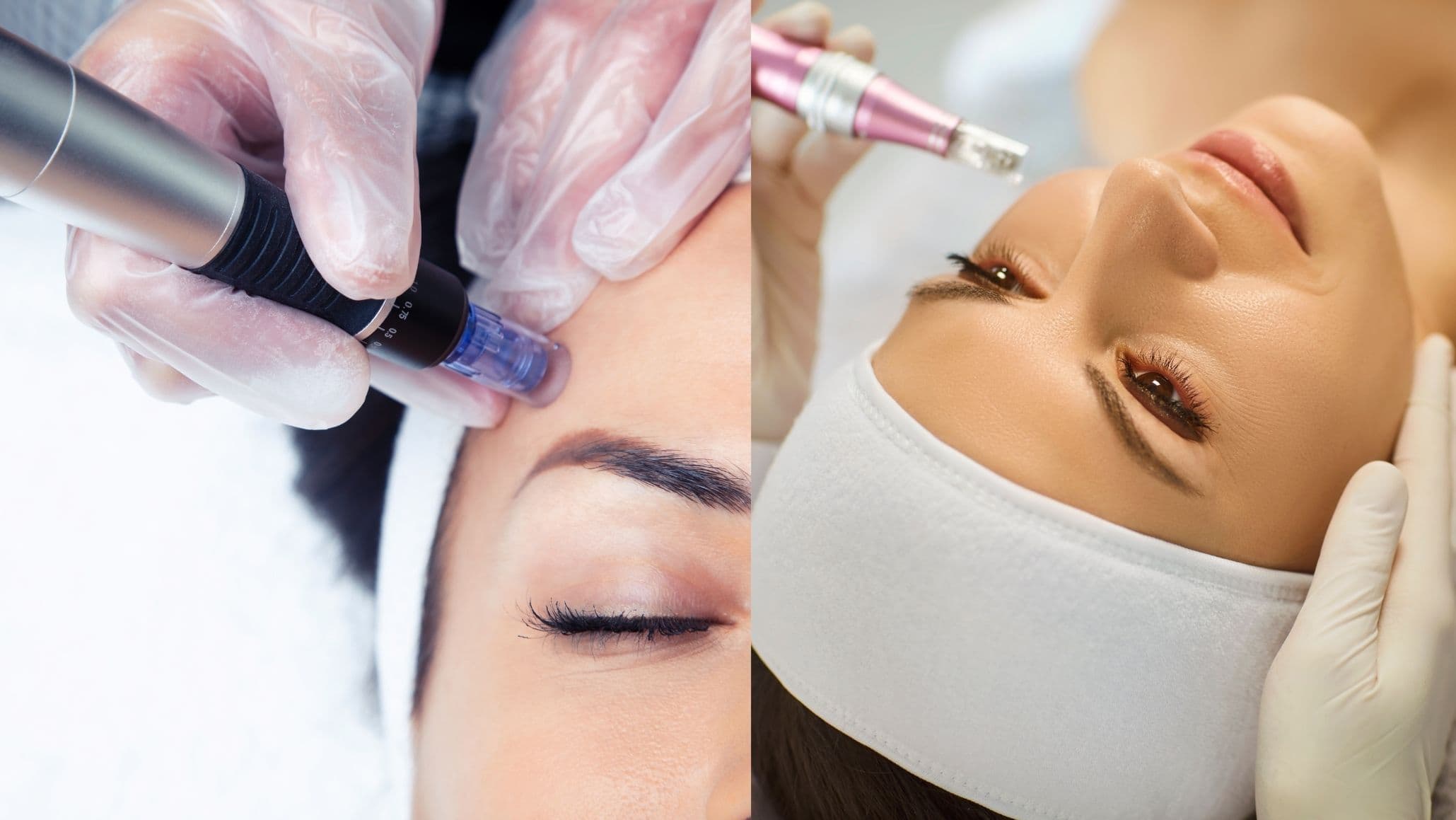Micro Needling Skincare Treatment